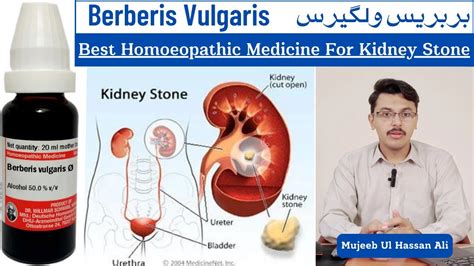 berberis for kidney stones.